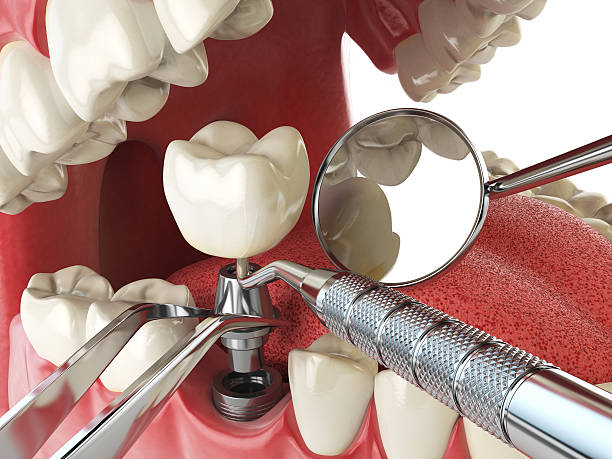 Best Emergency Cosmetic Dentistry (e.g., broken veneers) in Palm City, FL